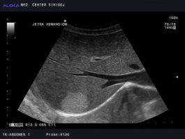 Ultrazvok trebuha - Jetrni hemangiom
